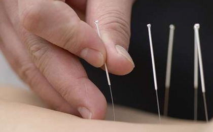 Scio ve Akupunktur